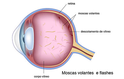 Moscas volantes