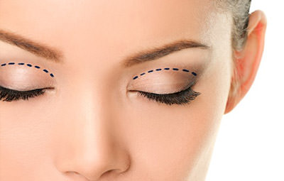 Blefaroplastia