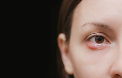 Cirurgia de Calázio