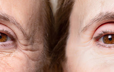 Atenuação de rugas de expressão